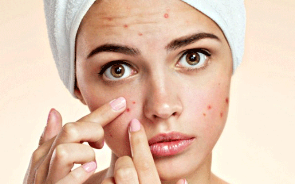 Eat right to keep acne away