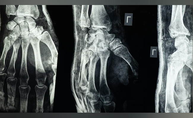 Chinese scientists unveil bone glue that repairs fractures in minutes