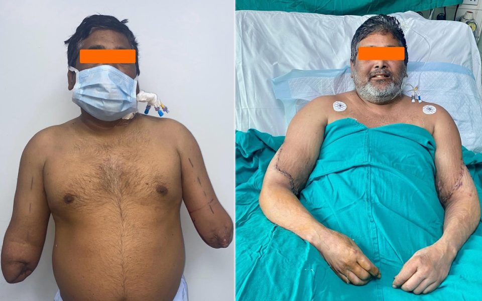 Train accident victim gets new hands in rare transplant at Delhi hospital