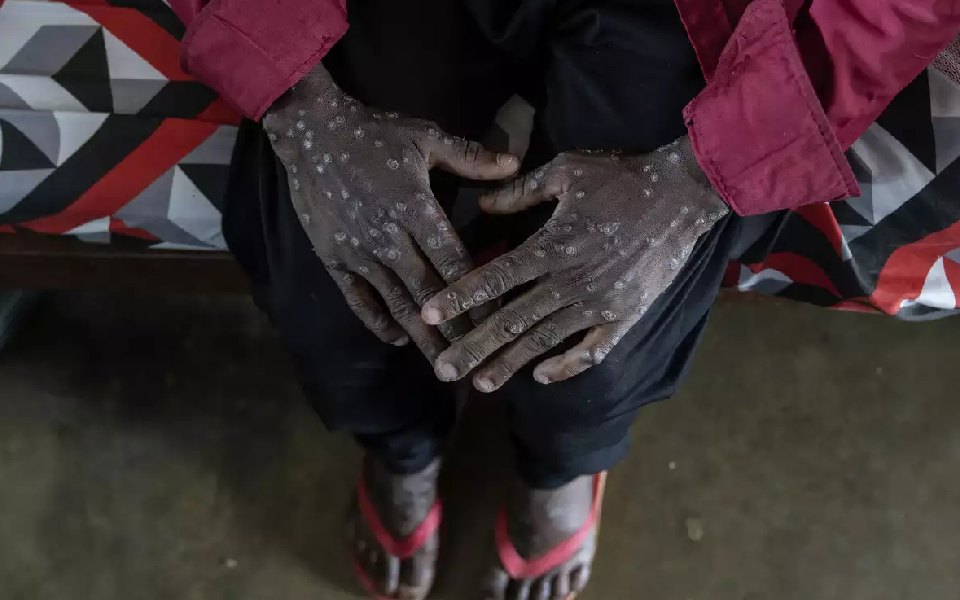 Suspected mpox case under probe, no cause for alarm: Govt