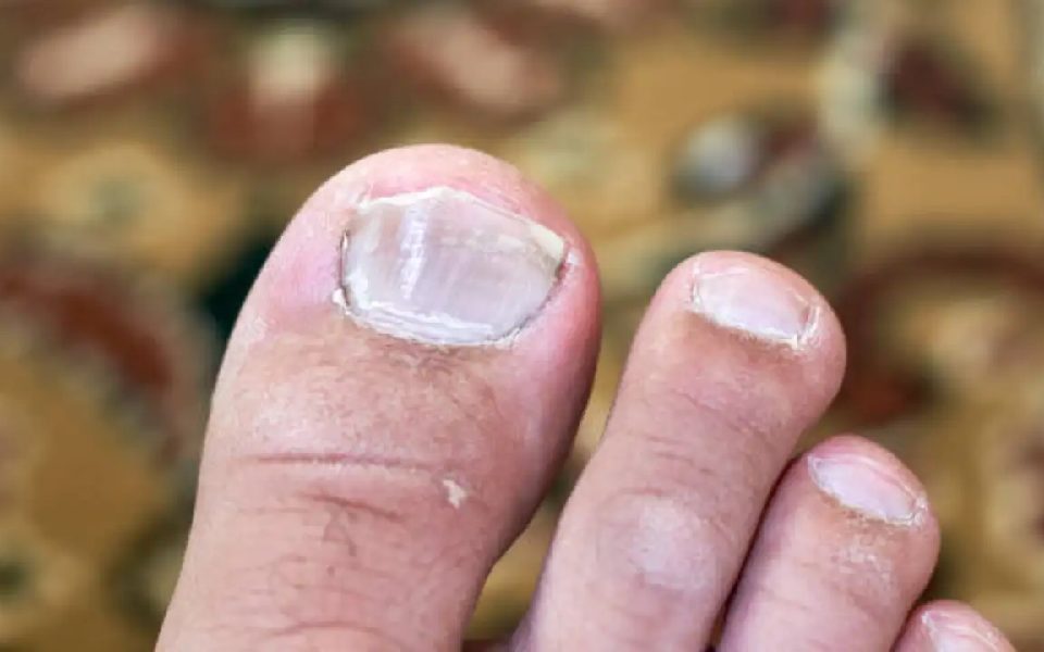 After hair loss, some villagers in Buldhana's Shegaon complain of nail problems; selenium link cited