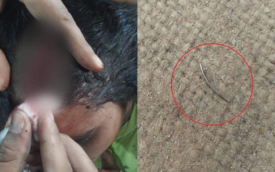 UP: Family claims needle left in woman's head after stitches at CHC, probe ordered