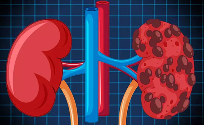 Maharashtra farmer’s kidney sale in Cambodia exposes suspected international organ racket