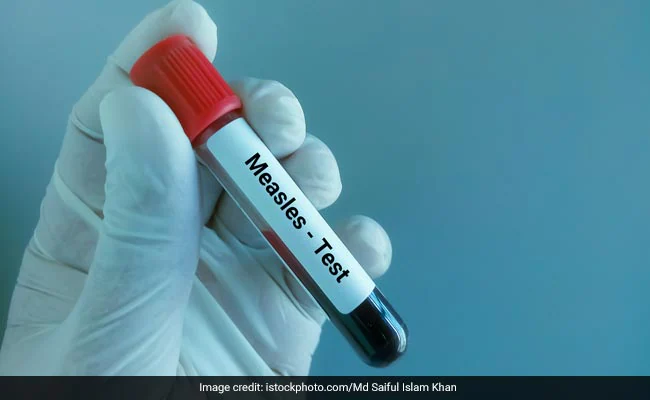 Mumbai sees 24 fresh measles cases and one suspected death: BMC