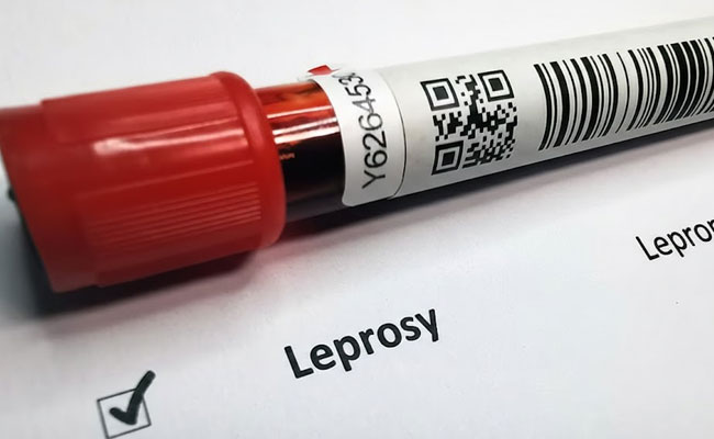 Health Department launches leprosy awareness campaign in Dakshina Kannada, district reports 47 cases