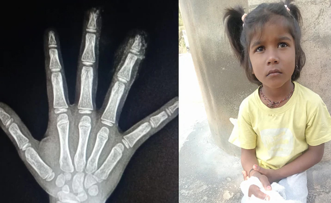 Six-year-old girl loses two fingers after they get caught in school door