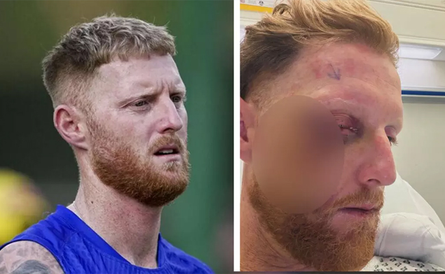 Stokes undergoes successful eye surgery