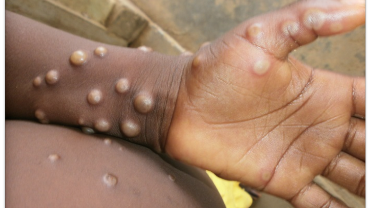 Monkeypox outbreak reported in 11 countries, WHO calls for emergency meet; All you need to know