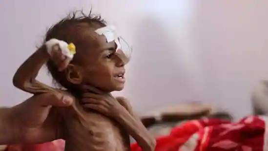 At least 400,000 Yemeni children under 5 could die of starvation this year - UN agencies