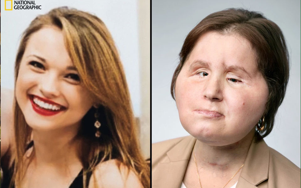 US girl who shot herself under her chin gets face transplant